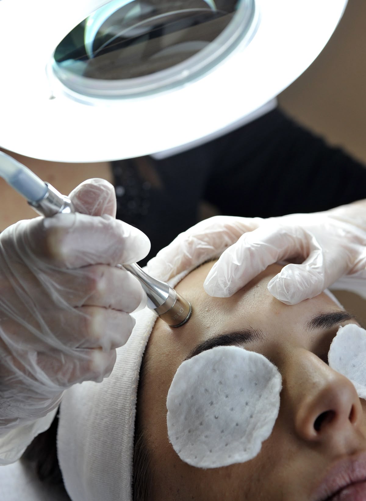 Microdermabrasion